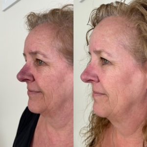 IPL Before and After
