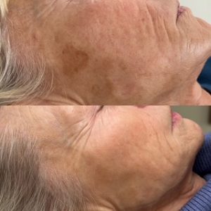 Lumecca IPL Before and After