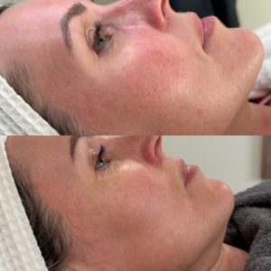 Vascular Improvement Before and After